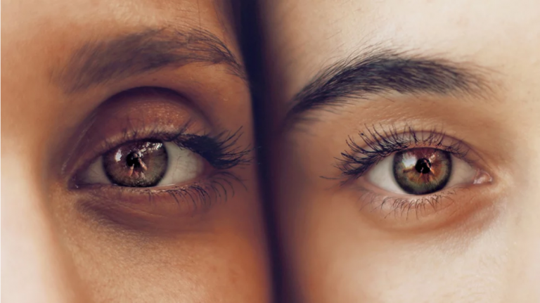 Best Dermatologist-Recommended Treatments for Dark Circles