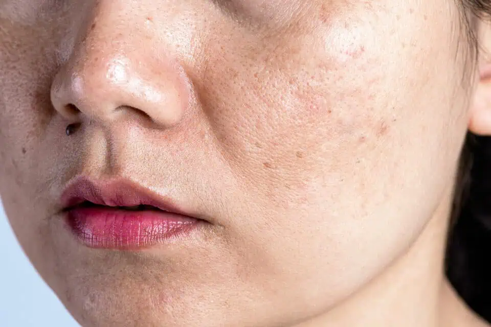 Understanding the Culprits Why Do I Have Enlarged Pores and Uneven Texture