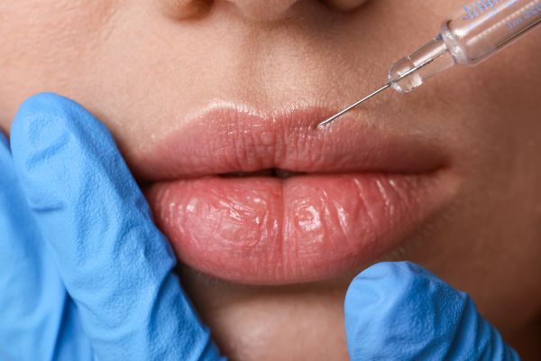 Lip Filler​