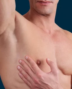 Male chest laser hair removal treatment area