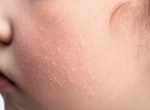 Close up of razor bumps and irritated skin caused by ingrown hairs before laser hair removal in Glendale